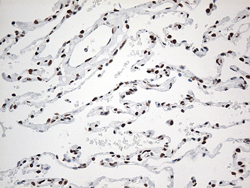 EWSR1 / EWS Antibody - Immunohistochemical staining of paraffin-embedded Human lung tissue within the normal limits using anti-EWSR1 mouse monoclonal antibody. (Heat-induced epitope retrieval by 1mM EDTA in 10mM Tris buffer. (pH8.5) at 120°C for 3 min. (1:500)