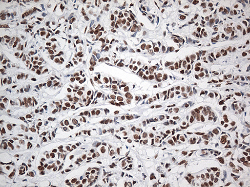 EWSR1 / EWS Antibody - Immunohistochemical staining of paraffin-embedded Adenocarcinoma of Human breast tissue tissue using anti-EWSR1 mouse monoclonal antibody. (Heat-induced epitope retrieval by 1mM EDTA in 10mM Tris buffer. (pH8.5) at 120°C for 3 min. (1:500)