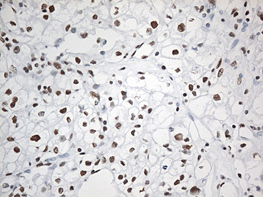 EWSR1 / EWS Antibody - Immunohistochemical staining of paraffin-embedded Carcinoma of Human kidney tissue using anti-EWSR1 mouse monoclonal antibody. (Heat-induced epitope retrieval by 1mM EDTA in 10mM Tris buffer. (pH8.5) at 120°C for 3 min. (1:500)