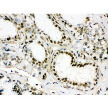 EWSR1 / EWS Antibody - EWSR1 antibody IHC-paraffin. IHC(P): Human Mammary Cancer Tissue.