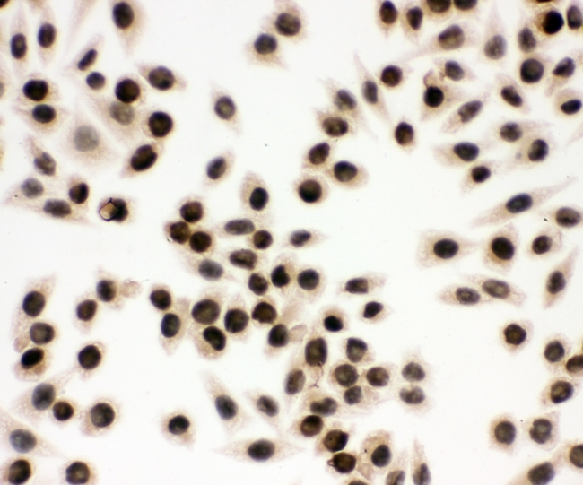 EWSR1 / EWS Antibody - IHC analysis of EWSR1 using anti-EWSR1 antibody. EWSR1 was detected in immunocytochemical section of human SMMC-7721 cell. Heat mediated antigen retrieval was performed in citrate buffer (pH6, epitope retrieval solution) for 20 mins. The tissue section was blocked with 10% goat serum. The tissue section was then incubated with 1µg/ml rabbit anti-EWSR1 Antibody overnight at 4°C. Biotinylated goat anti-rabbit IgG was used as secondary antibody and incubated for 30 minutes at 37°C. The tissue section was developed using Strepavidin-Biotin-Complex (SABC) with DAB as the chromogen.