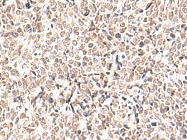 EWSR1 / EWS Antibody - Immunohistochemistry of paraffin-embedded Human lung cancer tissue  using EWSR1 Polyclonal Antibody at dilution of 1:70(×200)