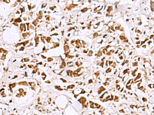 EWSR1 / EWS Antibody - Immunohistochemistry of paraffin-embedded Human breast cancer tissue  using EWSR1 Polyclonal Antibody at dilution of 1:60(×200)