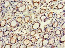 EXD2 Antibody - Immunohistochemistry of paraffin-embedded human gastric cancer at dilution 1:100