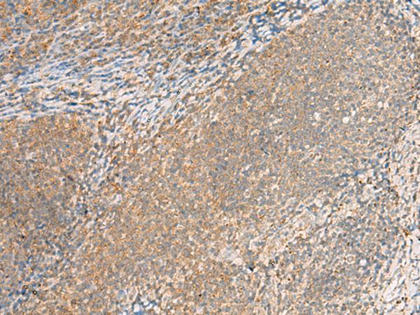 EXD2 Antibody - Immunohistochemistry of paraffin-embedded Human tonsil tissue  using EXD2 Polyclonal Antibody at dilution of 1:55(×200)