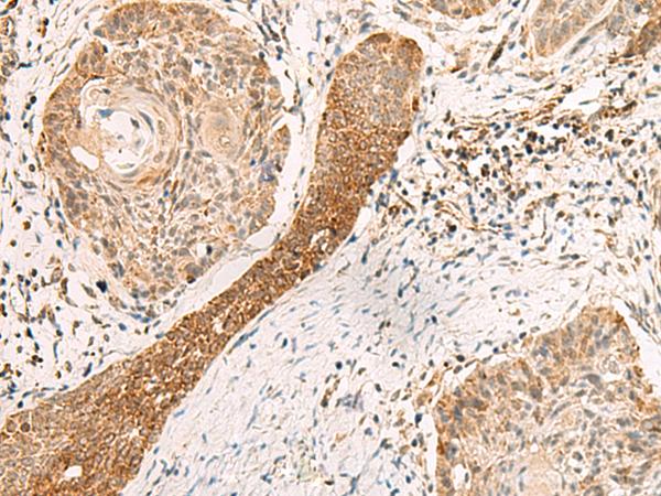 EXD2 Antibody - Immunohistochemistry of paraffin-embedded Human esophagus cancer tissue  using EXD2 Polyclonal Antibody at dilution of 1:55(×200)