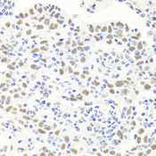 EXO1 Antibody - Immunohistochemistry of paraffin-embedded human esophageal cancer tissue.