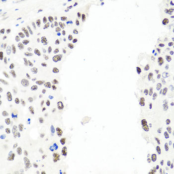 EXO1 Antibody - Immunohistochemistry of paraffin-embedded human lung cancer tissue.