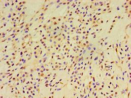 EXOC2 / SEC5 Antibody - Immunohistochemistry of paraffin-embedded human breast cancer using antibody at 1:100 dilution.