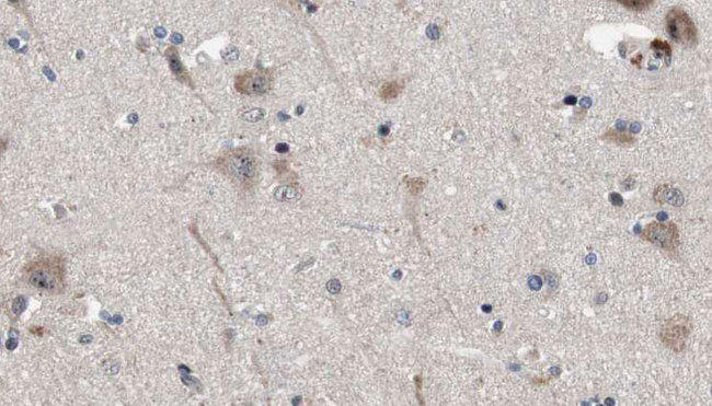 EXOC2 / SEC5 Antibody - 1:100 staining human brain carcinoma tissue by IHC-P. The sample was formaldehyde fixed and a heat mediated antigen retrieval step in citrate buffer was performed. The sample was then blocked and incubated with the antibody for 1.5 hours at 22°C. An HRP conjugated goat anti-rabbit antibody was used as the secondary.