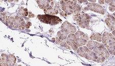 EXOC5 Antibody - 1:100 staining human pancreas carcinoma tissue by IHC-P. The sample was formaldehyde fixed and a heat mediated antigen retrieval step in citrate buffer was performed. The sample was then blocked and incubated with the antibody for 1.5 hours at 22°C. An HRP conjugated goat anti-rabbit antibody was used as the secondary.