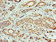 EXOG / ENDOGL1 Antibody - Immunohistochemistry of paraffin-embedded human breast cancer using antibody at 1:100 dilution.