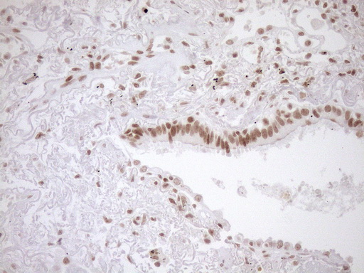 EXOSC1 / CSL4 Antibody - Immunohistochemical staining of paraffin-embedded Carcinoma of Human lung tissue using anti-EXOSC1 mouse monoclonal antibody. (Heat-induced epitope retrieval by 1mM EDTA in 10mM Tris buffer. (pH8.5) at 120°C for 3 min. (1:150)