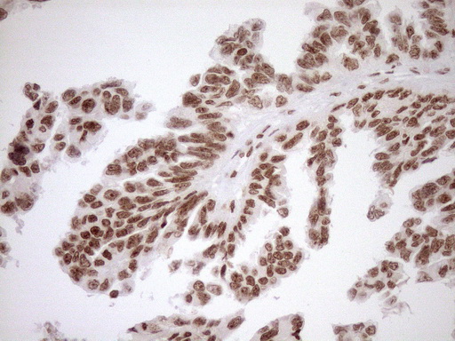 EXOSC1 / CSL4 Antibody - Immunohistochemical staining of paraffin-embedded Adenocarcinoma of Human ovary tissue using anti-EXOSC1 mouse monoclonal antibody. (Heat-induced epitope retrieval by 1mM EDTA in 10mM Tris buffer. (pH8.5) at 120°C for 3 min. (1:150)
