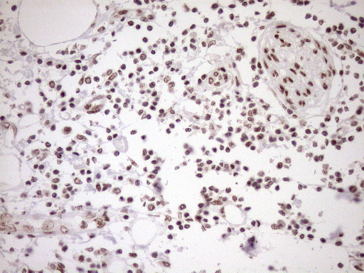 EXOSC1 / CSL4 Antibody - Immunohistochemical staining of paraffin-embedded Carcinoma of Human pancreas tissue using anti-EXOSC1 mouse monoclonal antibody. (Heat-induced epitope retrieval by 1mM EDTA in 10mM Tris buffer. (pH8.5) at 120°C for 3 min. (1:150)