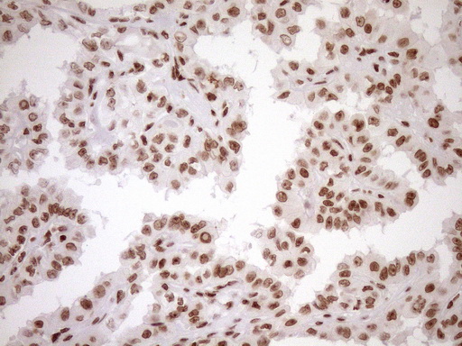 EXOSC1 / CSL4 Antibody - Immunohistochemical staining of paraffin-embedded Carcinoma of Human thyroid tissue using anti-EXOSC1 mouse monoclonal antibody. (Heat-induced epitope retrieval by 1mM EDTA in 10mM Tris buffer. (pH8.5) at 120°C for 3 min. (1:150)
