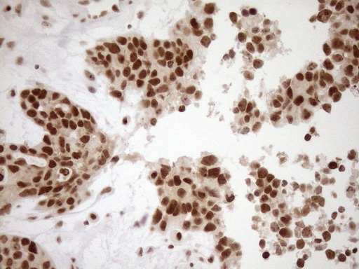 EXOSC1 / CSL4 Antibody - Immunohistochemical staining of paraffin-embedded Adenocarcinoma of Human endometrium tissue using anti-EXOSC1 mouse monoclonal antibody. (Heat-induced epitope retrieval by 1mM EDTA in 10mM Tris buffer. (pH8.5) at 120°C for 3 min. (1:150)