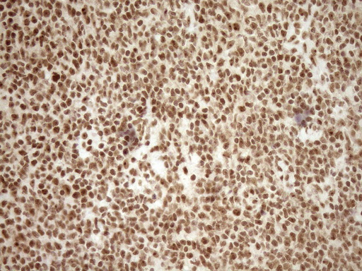 EXOSC1 / CSL4 Antibody - Immunohistochemical staining of paraffin-embedded Human lymphoma tissue using anti-EXOSC1 mouse monoclonal antibody. (Heat-induced epitope retrieval by 1mM EDTA in 10mM Tris buffer. (pH8.5) at 120°C for 3 min. (1:150)