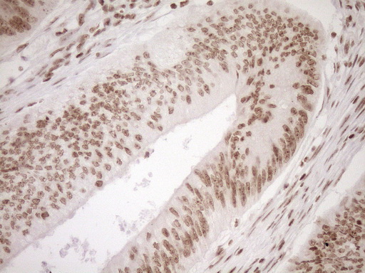 EXOSC1 / CSL4 Antibody - Immunohistochemical staining of paraffin-embedded Adenocarcinoma of Human colon tissue using anti-EXOSC1 mouse monoclonal antibody. (Heat-induced epitope retrieval by 1mM EDTA in 10mM Tris buffer. (pH8.5) at 120°C for 3 min. (1:150)