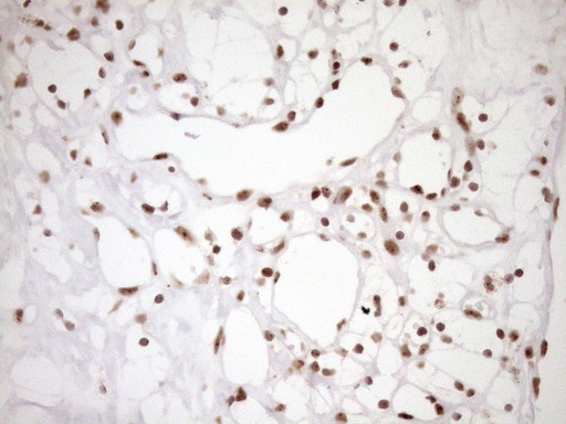 EXOSC1 / CSL4 Antibody - Immunohistochemical staining of paraffin-embedded Carcinoma of Human kidney tissue using anti-EXOSC1 mouse monoclonal antibody. (Heat-induced epitope retrieval by 1mM EDTA in 10mM Tris buffer. (pH8.5) at 120°C for 3 min. (1:150)