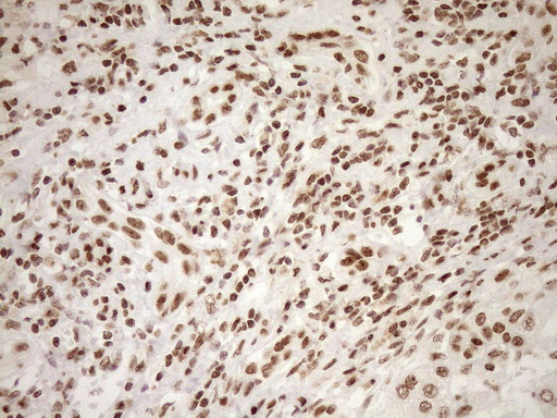 EXOSC1 / CSL4 Antibody - Immunohistochemical staining of paraffin-embedded Carcinoma of Human liver tissue using anti-EXOSC1 mouse monoclonal antibody. (Heat-induced epitope retrieval by 1mM EDTA in 10mM Tris buffer. (pH8.5) at 120°C for 3 min. (1:150)