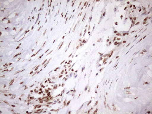 EXOSC1 / CSL4 Antibody - Immunohistochemical staining of paraffin-embedded Carcinoma of Human pancreas tissue using anti-EXOSC1 mouse monoclonal antibody. (Heat-induced epitope retrieval by 1mM EDTA in 10mM Tris buffer. (pH8.5) at 120 oC for 3 min. (1:150)