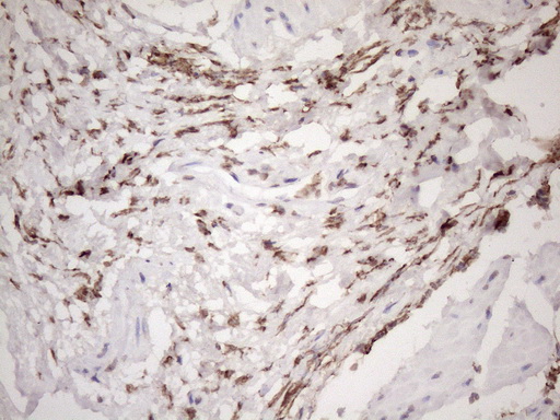 EXOSC1 / CSL4 Antibody - Immunohistochemical staining of paraffin-embedded Carcinoma of Human bladder tissue using anti-EXOSC1 mouse monoclonal antibody. (Heat-induced epitope retrieval by 1mM EDTA in 10mM Tris buffer. (pH8.5) at 120 oC for 3 min. (1:150)