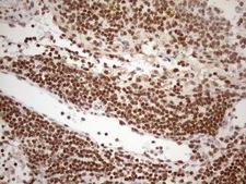 EXOSC1 / CSL4 Antibody - Immunohistochemical staining of paraffin-embedded Carcinoma of Human thyroid tissue using anti-EXOSC1 mouse monoclonal antibody. (Heat-induced epitope retrieval by 1mM EDTA in 10mM Tris buffer. (pH8.5) at 120 oC for 3 min. (1:150)