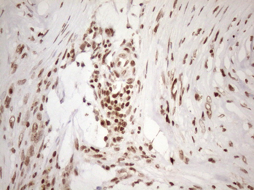EXOSC1 / CSL4 Antibody - Immunohistochemical staining of paraffin-embedded Carcinoma of Human pancreas tissue using anti-EXOSC1 mouse monoclonal antibody. (Heat-induced epitope retrieval by 1mM EDTA in 10mM Tris buffer. (pH8.5) at 120 oC for 3 min. (1:150)
