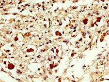 EXOSC10 Antibody - Immunohistochemistry image at a dilution of 1:300 and staining in paraffin-embedded human melanoma cancer performed on a Leica BondTM system. After dewaxing and hydration, antigen retrieval was mediated by high pressure in a citrate buffer (pH 6.0) . Section was blocked with 10% normal goat serum 30min at RT. Then primary antibody (1% BSA) was incubated at 4 °C overnight. The primary is detected by a biotinylated secondary antibody and visualized using an HRP conjugated SP system.