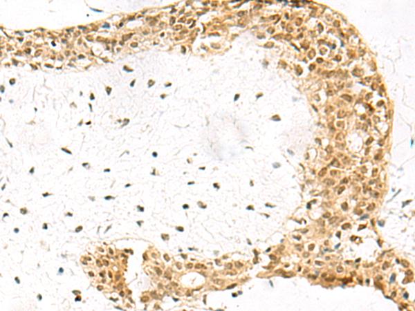 EXOSC4 / RRP41 Antibody - Immunohistochemistry of paraffin-embedded Human breast cancer tissue  using EXOSC4 Polyclonal Antibody at dilution of 1:70(×200)
