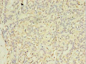 EXOSC5 Antibody - Immunohistochemistry of paraffin-embedded human breast cancer using EXOSC5 Antibody at dilution of 1:100