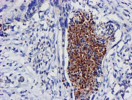 EXOSC7 Antibody - IHC of paraffin-embedded Carcinoma of Human pancreas tissue using anti-EXOSC7 mouse monoclonal antibody. (Heat-induced epitope retrieval by 10mM citric buffer, pH6.0, 100C for 10min).