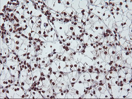 EXOSC7 Antibody - IHC of paraffin-embedded Carcinoma of Human kidney tissue using anti-EXOSC7 mouse monoclonal antibody.