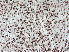 EXOSC7 Antibody - IHC of paraffin-embedded Carcinoma of Human liver tissue using anti-EXOSC7 mouse monoclonal antibody.