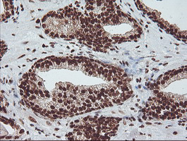 EXOSC7 Antibody - IHC of paraffin-embedded Carcinoma of Human prostate tissue using anti-EXOSC7 mouse monoclonal antibody.