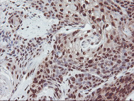 EXOSC7 Antibody - IHC of paraffin-embedded Carcinoma of Human bladder tissue using anti-EXOSC7 mouse monoclonal antibody.