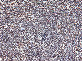 EXOSC7 Antibody - IHC of paraffin-embedded Human lymphoma tissue using anti-EXOSC7 mouse monoclonal antibody.