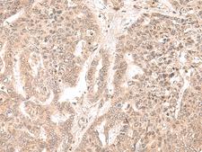 EXOSC9 / p5 Antibody - Immunohistochemistry of paraffin-embedded Human liver cancer tissue  using EXOSC9 Polyclonal Antibody at dilution of 1:35(×200)