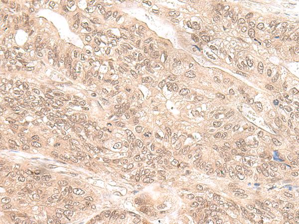 EXOSC9 / p5 Antibody - Immunohistochemistry of paraffin-embedded Human gastric cancer tissue  using EXOSC9 Polyclonal Antibody at dilution of 1:35(×200)