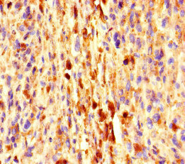 EXPH5 Antibody - Immunohistochemistry of paraffin-embedded human melanoma cancer at dilution of 1:100