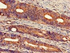 EXT2 Antibody - Immunohistochemistry of paraffin-embedded human colon cancer using EXT2 Antibody at dilution of 1:100