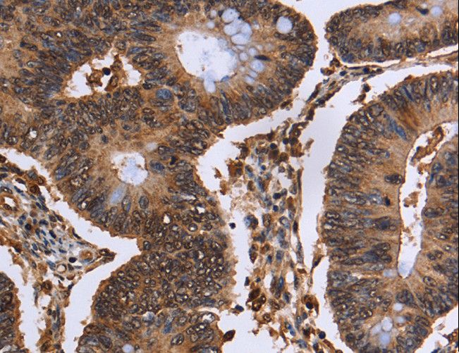 EXTL3 Antibody - Immunohistochemistry of paraffin-embedded Human colon cancer using EXTL3 Polyclonal Antibody at dilution of 1:50.