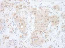 EYA2 Antibody - Detection of Human EYA2 by Immunohistochemistry. Sample: FFPE section of human breast carcinoma. Antibody: Affinity purified rabbit anti-EYA2 used at a dilution of 1:1000 (1 Detection: DAB.