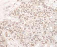 EYA2 Antibody - Detection of Human EYA2 by Immunohistochemistry. Sample: FFPE section of human breast carcinoma. Antibody: Affinity purified rabbit anti-EYA2 used at a dilution of 1:250.