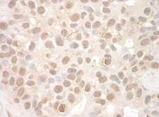 EYA2 Antibody - Detection of Human EYA2 by Immunohistochemistry. Sample: FFPE section of human breast carcinoma. Antibody: Affinity purified rabbit anti-EYA2 used at a dilution of 1:1000 (1 Detection: DAB.