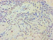 EYA2 Antibody - Immunohistochemistry of paraffin-embedded human breast cancer using EYA2 Antibody at dilution of 1:100