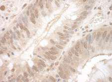 EYA3 Antibody - Detection of Human EYA3 by Immunohistochemistry. Sample: FFPE section of human colon carcinoma. Antibody: Affinity purified rabbit anti-EYA3 used at a dilution of 1:250.
