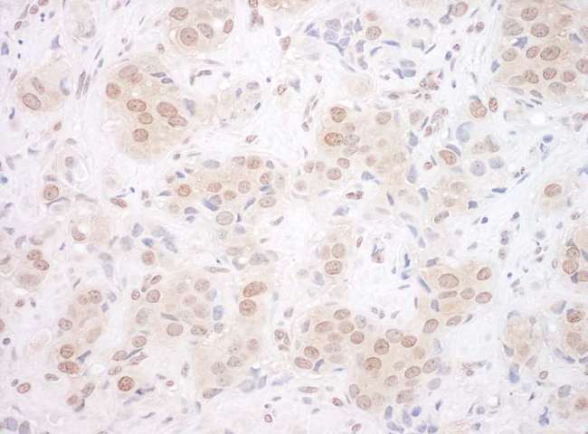 EYA3 Antibody - Detection of Human EYA3 by Immunohistochemistry. Sample: FFPE section of human breast carcinoma. Antibody: Affinity purified rabbit anti-EYA3 used at a dilution of 1:200 (1 Detection: DAB.