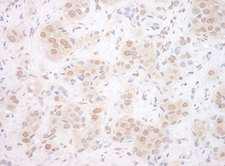 EYA3 Antibody - Detection of Human EYA3 by Immunohistochemistry. Sample: FFPE section of human breast carcinoma. Antibody: Affinity purified rabbit anti-EYA3 used at a dilution of 1:200 (1 Detection: DAB.